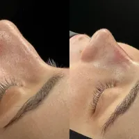 عمل جراحی بینی وترمیم باپیزو/لیفت صورت وپلک|خدمات آرایشگری و زیبایی|کرج, چهارصد دستگاه|دیوار
