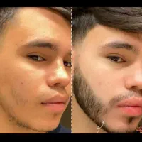 کم پشتی و رویش و پرپشتی کامل ریش سیبیل