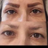 جشنواره بلفاروپلاستی