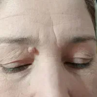 برداشتن انواع خال و لک بادستگاه پزشکی در1جلسه