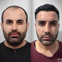 کاشت مو پرتراکم و تضمینی فقط ۱۵ میلیون|خدمات آرایشگری و زیبایی|تهران, جردن|دیوار