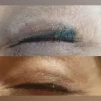 ۵۰درصد تخفیف پاک کردن تاتو .فشیال وپاکسازی|خدمات آرایشگری و زیبایی|قرچک, زیبا شهر|دیوار