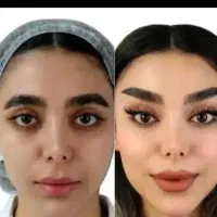 تخفیفات جشنواره به مدت محدود خدمات فیلرو ژل