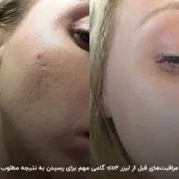 جوانسازی پوست و نواحی بانوان با لیزر تخصصی فوتونا|خدمات آرایشگری و زیبایی|محمدیه-قزوین, |دیوار
