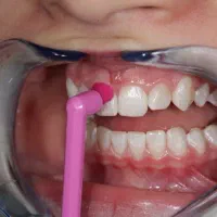 قسطی ایمپلنت و تمام خدمات دندانپزشکی بدون پیش|خدمات آرایشگری و زیبایی|اصفهان, دشتستان|دیوار