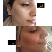 تزریقات تخصصی ژل و بوتاکس|خدمات آرایشگری و زیبایی|اهواز, شهرک دانشگاه|دیوار