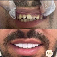 عصب کشی ترمیم کامپوزیت|خدمات آرایشگری و زیبایی|قم, نوقطار|دیوار