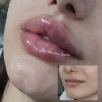 تزریق ژل و بوتاکس و مزوتراپی/ژل لب M تکنیک|خدمات آرایشگری و زیبایی|مشهد, نیروی هوایی|دیوار