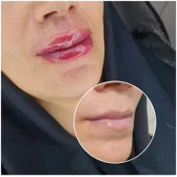 تخفیف ویژه بوتاکس،فیلر،مزو،لیزر موهای زائد کندلا|خدمات آرایشگری و زیبایی|کرج, فاز ۲ مهرشهر|دیوار