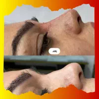 تخفیف ژل لب و بوتاکس فیلر مزو دکتر کاظمی
