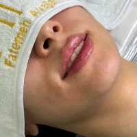 ژل بوتاکس آنزیم پرسینگ