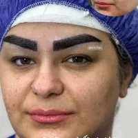 کاشت مو15/800 ابرو11/800چک صیادی دکتر اسماعیلی
