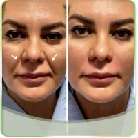 هدیه روز مادر آف ژل وبوتاکس|خدمات آرایشگری و زیبایی|ایذه, |دیوار