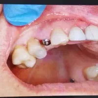 مرکز فوق تخصصی ایمپلنت دیجیتال مشهد/یکروزه/اقساطی