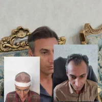 کاشتمو تضمینی و تراکم عالی زیر نظر پزشک|خدمات آرایشگری و زیبایی|مشهد, فردوسی|دیوار