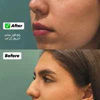 بوتاکس۷۰۰فول فیس۵۸۰۰ترمیم رایگان نمونه کارا واقعی