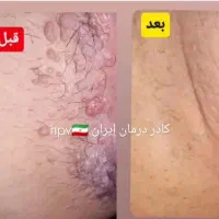 رفع دائمی زگیل و تبخال تناسلی|آرایشی، بهداشتی، درمانی|شیراز, شهرک گلها|دیوار