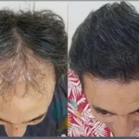 درمان ریزش مو و ریش بانوان و آقایان