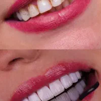 تخفیف روکش زیرکونا و پی اف ام نقد+اقساط