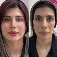 ژل و بوتاکس کاشت ابرو قسطی|خدمات آرایشگری و زیبایی|یاسوج, |دیوار