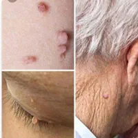 مرکز تخصصی خال و زگیل ذگیل تناسلی لیزر،کرایو|خدمات آرایشگری و زیبایی|تهران, جمهوری|دیوار