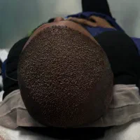 کاشت مو با تخفیف ویژه به مدت محدود|خدمات زیبایی و سلامت|تبریز, |دیوار