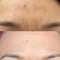 مزونیدلینگ ، PRP ، مزوتراپی صورت و مو|خدمات آرایشگری و زیبایی|دوگنبدان, |دیوار