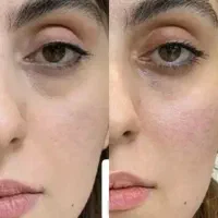 جشنواره درمان کک ومک/لک/خال/ریزش مودریک جلسه|خدمات آرایشگری و زیبایی|اصفهان, طامه|دیوار