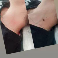 خالبرداری پوست
