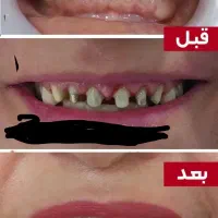 دندانپزشکی صدف (با شرایط اقساط) کامپوزیت|خدمات آرایشگری و زیبایی|قم, حقیقت|دیوار