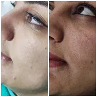 رفع تیرگی پلاژن تراپی