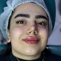 بلفاروپلاستی تضمینی تزریق فیلر بوتاکس و لیزر اقساط|خدمات آرایشگری و زیبایی|تبریز, |دیوار