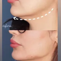 جشنواره ژل و فیلر بوتاکس پی آر پی مزو جوانساز لیزر|خدمات آرایشگری و زیبایی|رشت, گلسار|دیوار