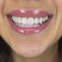 کامپوزیت دندان کامپوزیت زیبایی ایمپلنت لمینیت