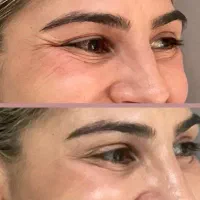 بوتاکس ۵۰۰