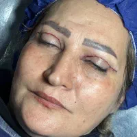 جشنواره تخفیف بلفاروپلاستی(جراحی افتادگی پلک)