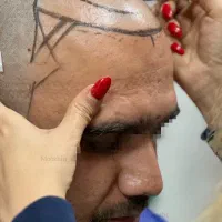 کاشت مو آقایان خط موی عروسکی نداشته باش