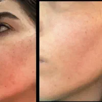 تکنیک پوست بچه، خاویار تراپی، آلگاپیل،پوست کره ای