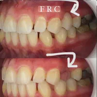 خدمات دندان بریچ frc جایگزین ایمپلنت|خدمات آرایشگری و زیبایی|اهواز, کیانپارس |دیوار