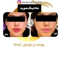 جشنواره تزریق ژل ۳۸۰ هزاروبوتاکس توسط کادردرمان|خدمات آرایشگری و زیبایی|اندیمشک, |دیوار