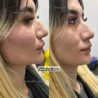 تزریق بایوفیلر کل صورت نچرال و طبیعی|خدمات آرایشگری و زیبایی|پاکدشت, پاکدشت (مامازند)|دیوار