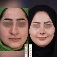 جراحی بینی ابدوساکشن بلفارو(پلک)غبغب تیپ پلاستی|خدمات آرایشگری و زیبایی|مشهد, احمدآباد|دیوار