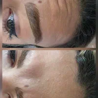 لیزرموهای زائد،ژل وبوتاکس،پی آرپی.فیلربادی،بلفارو|خدمات زیبایی و سلامت|تهران, شکوفه|دیوار