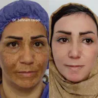 لیزرco2فرکشنال ترکیبی ،جوانسازتک جلسه ای تزریق ژل