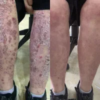 درمان پیـسی و پسـوریـازیس و تمام مشکـلات پـوستی