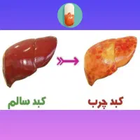 درمان کبد چرب