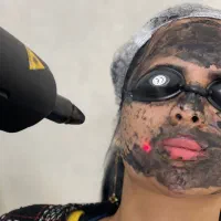 لیزر موهای زائد بدن،پاک کردن تاتو،پیلینگ هالیوددی|خدمات آرایشگری و زیبایی|قرچک, زیبا شهر|دیوار