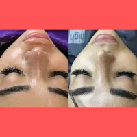 پاکسازی و فیشال صورت