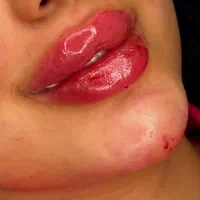 آموزش فیلر،بوتاکس