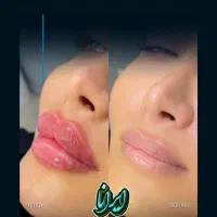 تزریق ژل و بوتاکس تضمینی (کلنیک ایرانا)